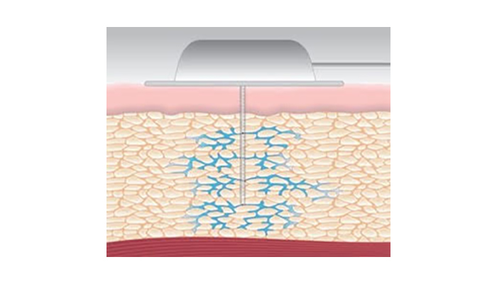 Capillary Med Tech Capillary Biomedical raises $3m to support insulin infusion tech ...