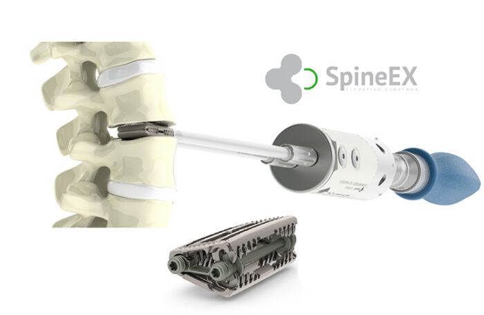 Modulex Spinal System SpineEx registers $17m IPO - MassDevice