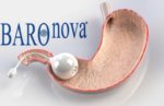 BaroNova