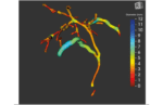 Perspectum Diagnostics biliary visualization software