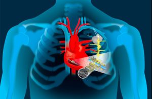 Could this device replace pacemaker batteries? - MassDevice