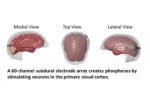 Second Sight Medical's Orion cortical implant