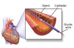coronary stent