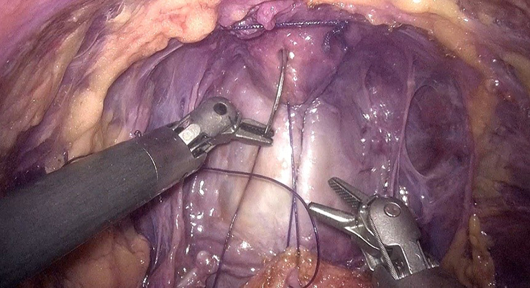 Medtronic robot-assisted surgery system