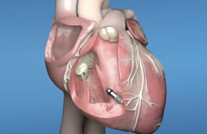 Medtronic Micra AV leadless pacemaker