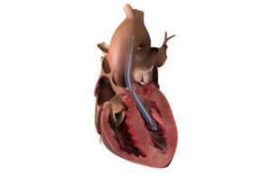 Abiomed Impella 5.5 with SmartAssist heart pump