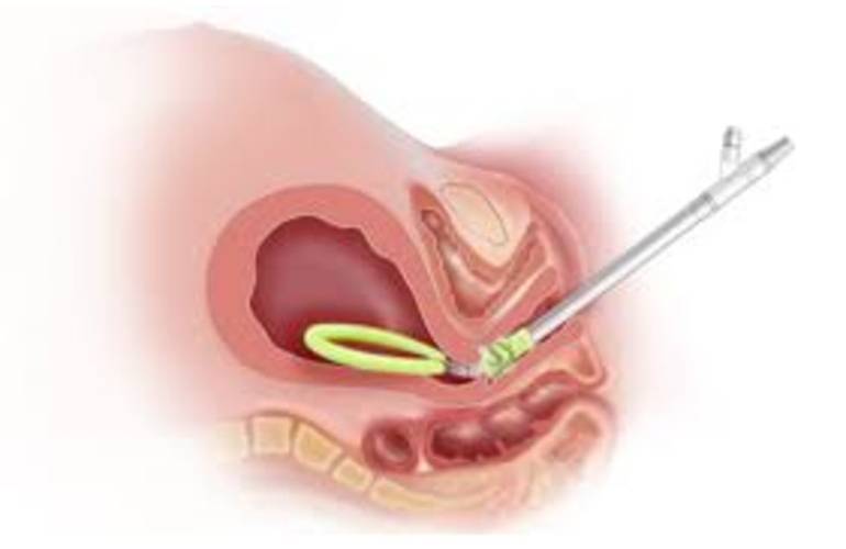 Organon completes divestiture of Jada intrauterine vacuum device to Laborie