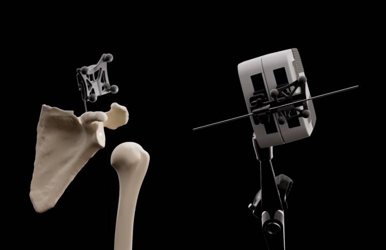 Interventional Systems, Shoulder Innovations partner on shoulder-specific micro robotics