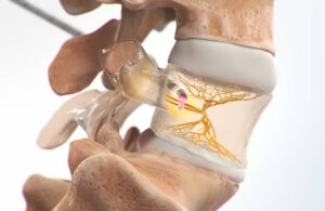 Boston Scientific Intracept Procedure w Ablation