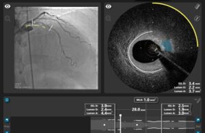 SpectraWave Deep OCT imaging Philips (1)