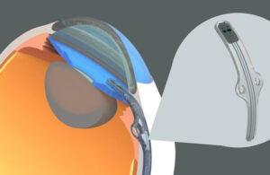 An image of Myra Vision's Calibreye aqueous shunt for glaucoma patients.