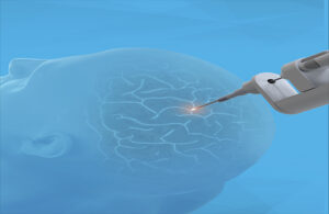 Monteris’ NueroBlate system using laser energy through a small hole in the skull.