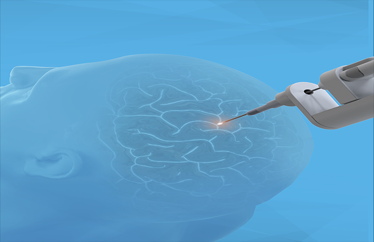 Monteris wins Tricare coverage for minimally invasive neurosurgery