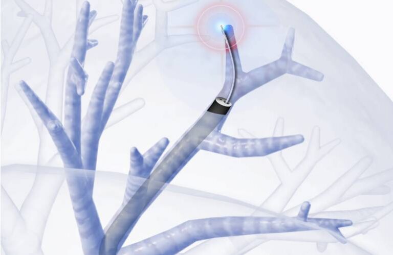 Leadoptik reports first-in-human use of lung biopsy tech