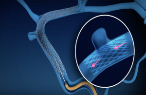 An image of a novel stent called BosSTENT within a vein.