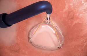 An image of the Valcare annuloplasty system in vivo.