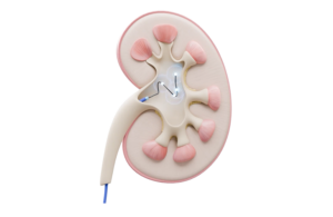 Verve Medical marketing illustration of pelvic renal denervation PRD