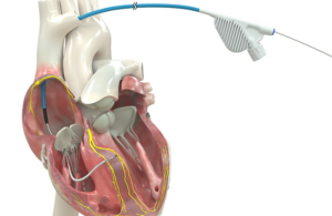 Medtronic OmniaSecure defibrillation lead cleared for left bundle branch area pacing