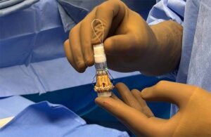 A surgeon holding Corcym's Perceval Lancelot aortic valve prior to implantation
