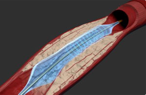 Amplitude Vascular Systems AVS IVL intravascular lithotripsy acquired by Stryker