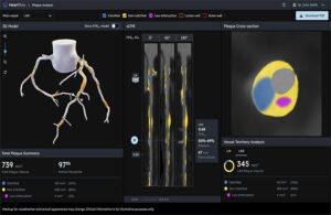 An image of HeartFlow’s Plaque Analysis algorithm software.
