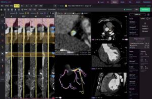 An image of Cleerly’s Plaque Analysis software