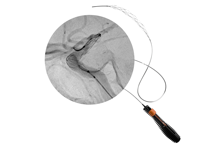 Rapid Medical earns FDA clearance for latest Tigertriever device