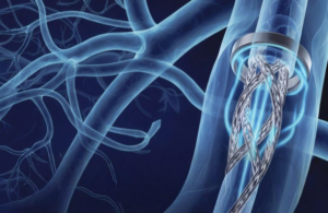 Sonorous Neurovascular BosCATH system