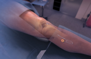 Nervonik peripheral nerve stimulation system