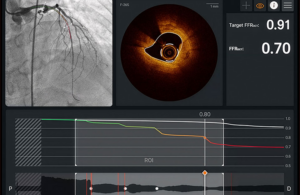 Abbott Ultreon 3.0 software