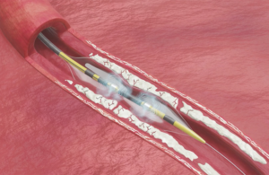Johnson & Johnson Shockwave C2 Aero IVL catheter