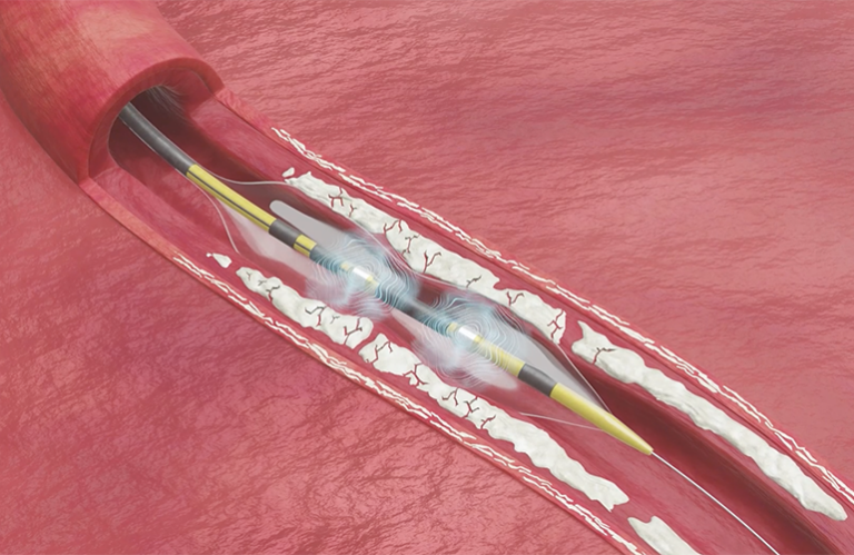 J&J CMO explains 'game-changer' Shockwave C2 Aero catheter