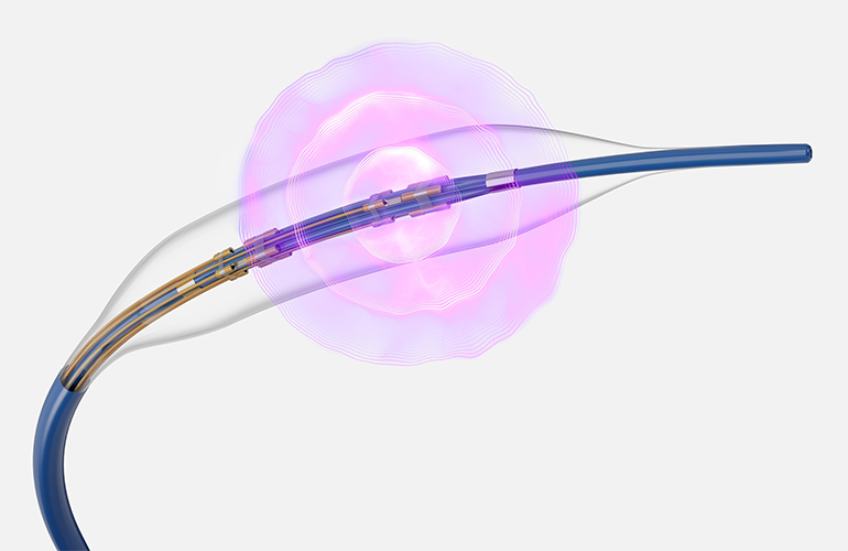 Boston Scientific study of Seismiq coronary IVL meets endpoints
