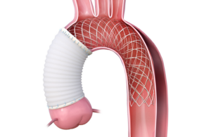 Artivion AMDS hybrid prosthesis