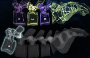 An illustration of Augmedics' CT-fluoro technology.