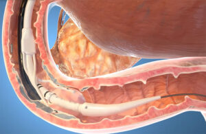 An illustration of Fractyl Health's Revita targeting the duodenal mucosa.