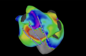 CoreMap ablation mapping animation