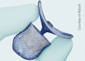 A close-up image of Abbott's Amulet 360 LAA device.