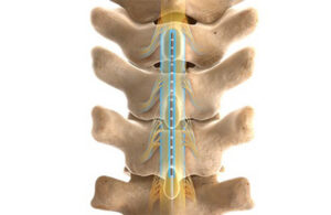 Boston Scientific's Infinion CX leads are used in its spinal cord stimulation systems (lead pictured here in the spine).