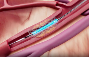 Cordis' Selution SLR drug-eluting balloon illustrated during a percutaneous coronary intervention procedure