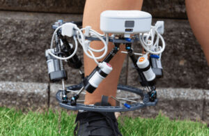 A photo of DePuy Synthes' Maxfram Autostrut on a patient.