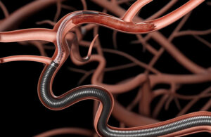An illustration of Perfuze Millipede88 at the site of occlusion.