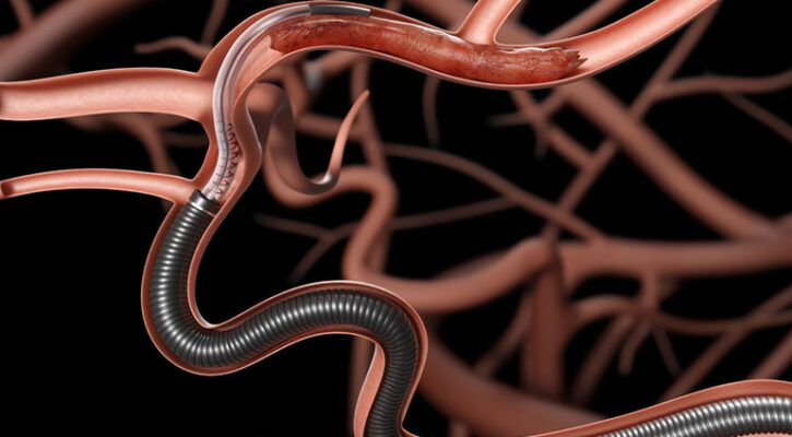 Perfuze’s super-bore stroke catheter tops conventional, cyclic aspiration in bench study