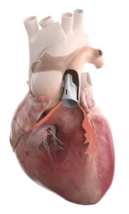 A photo of Edwards Lifesciences' Autus size-adjustable heart valve.