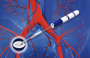 This is a Haemonetics image of the PerQseal Elite vascular closure system.