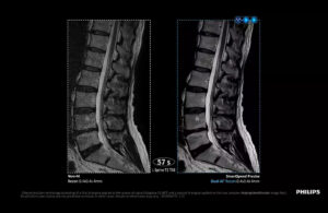 This Philips image shows side-by-side lumbar spine MRI images comparing non-AI reconstruction with Philips SmartSpeed Precise dual AI reconstruction from a 57-second scan.