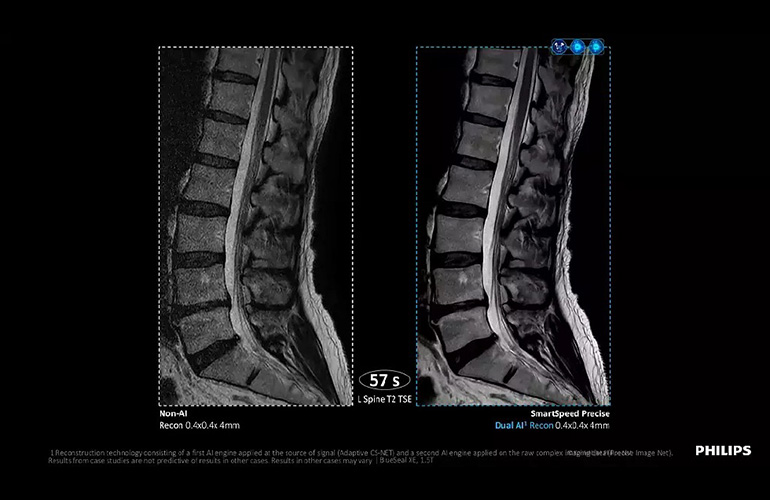Philips hits 1,000 installation mark for its AI-powered MRI software